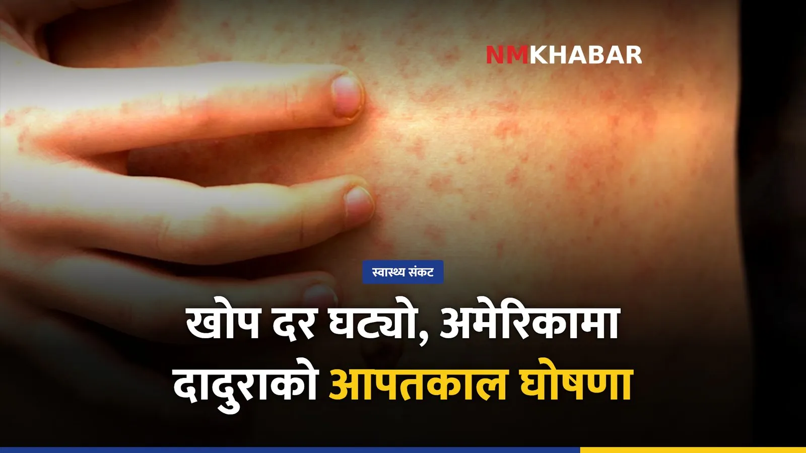 अमेरिका दादुरा खोप